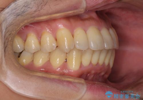 前歯のデコボコ ワイヤー装置での短期間治療の治療後