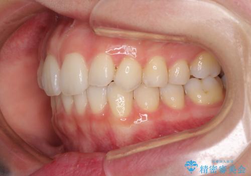 狭い上顎骨を拡大 急速拡大装置を併用したインビザライン矯正の治療中