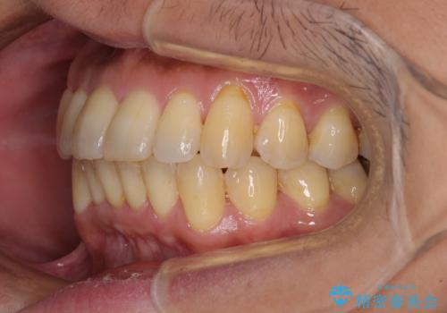 前歯のデコボコ ワイヤー装置での短期間治療の治療後