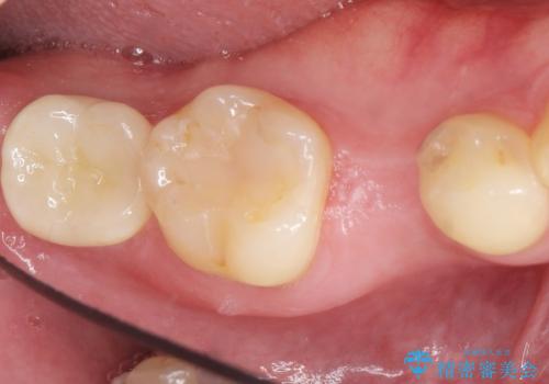 予算を抑えてしっかりとしたインプラント治療 30代男性の治療前