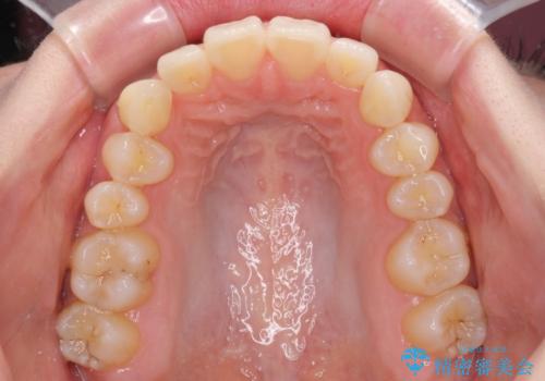 狭い上顎骨を拡大 急速拡大装置を併用したインビザライン矯正の治療中