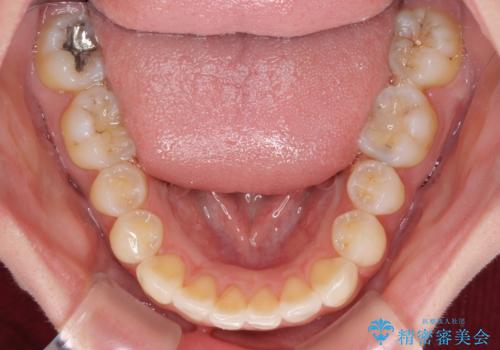 狭い上顎骨を拡大 急速拡大装置を併用したインビザライン矯正の治療中