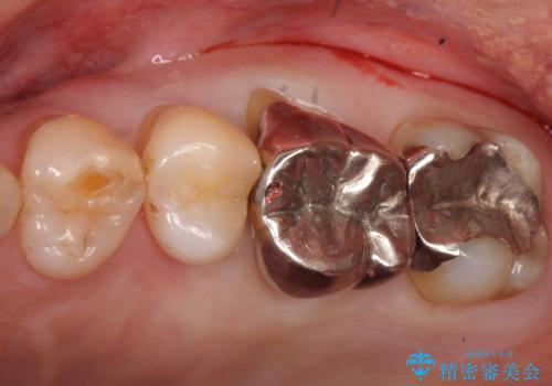 奥歯がわれている ソケットリフトを併用した奥歯のインプラント 60代男性の治療前