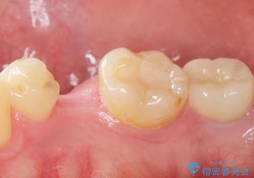 予算を抑えてしっかりとしたインプラント治療 30代男性の治療前