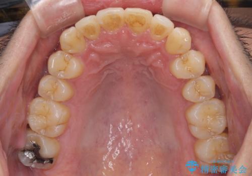 前歯のデコボコ　ワイヤー装置での短期間治療の治療後
