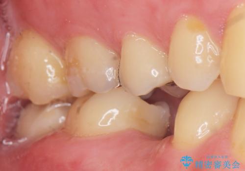 予算を抑えてしっかりとしたインプラント治療 30代男性の治療前