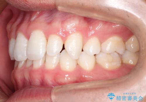 【インビザライン】笑った時の歯並びを綺麗にしたいの治療前
