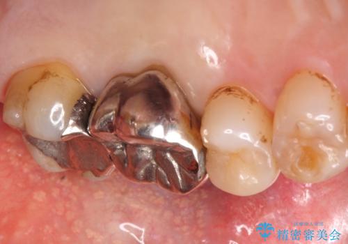 奥歯がわれている ソケットリフトを併用した奥歯のインプラント 60代男性の治療前