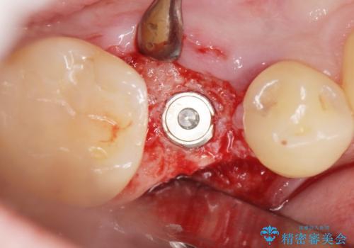 予算を抑えてしっかりとしたインプラント治療 30代男性の治療中