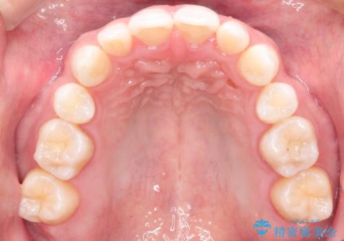 【インビザライン】笑った時の歯並びを綺麗にしたいの治療前