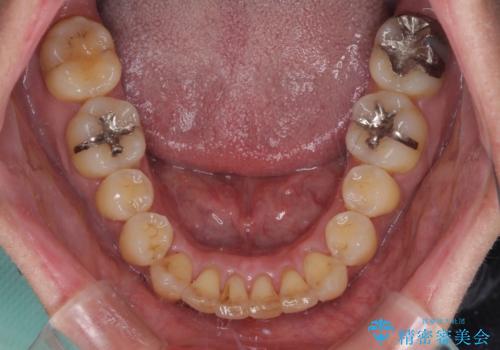 前歯のデコボコ　ワイヤー装置での短期間治療の治療後