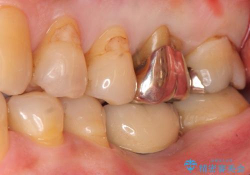 奥歯がわれている　ソケットリフトを併用した奥歯のインプラント　60代男性の症例 治療前