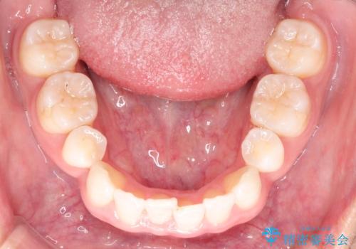 【インビザライン】笑った時の歯並びを綺麗にしたいの治療前