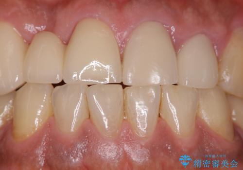 イベント前に綺麗な歯にしたいの治療前