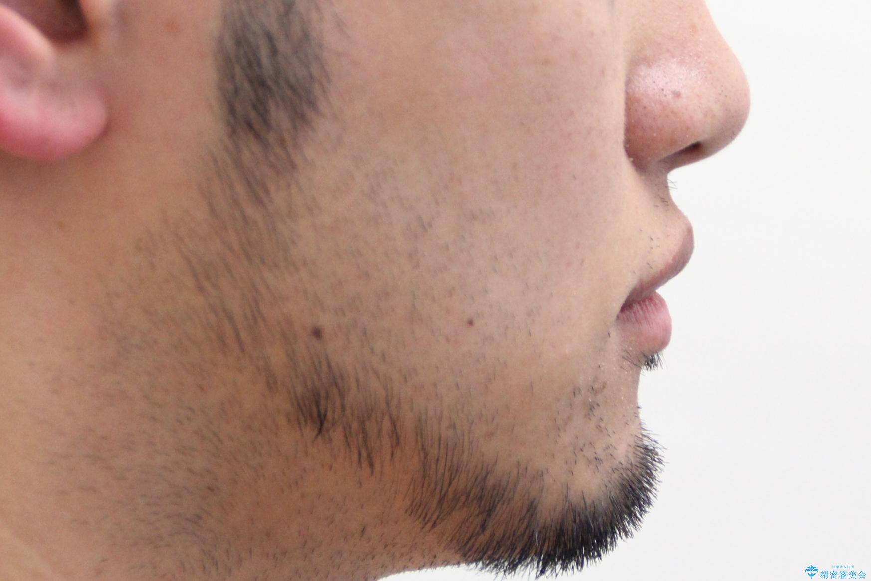 【インビザライン】笑った時の歯並びを綺麗にしたいの治療前(顔貌)