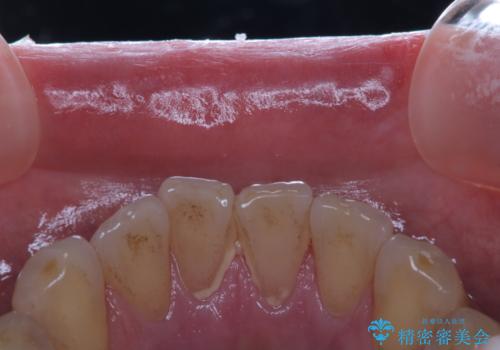 イベント前に綺麗な歯にしたいの治療前