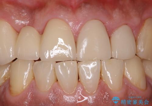 イベント前に綺麗な歯にしたいの治療後