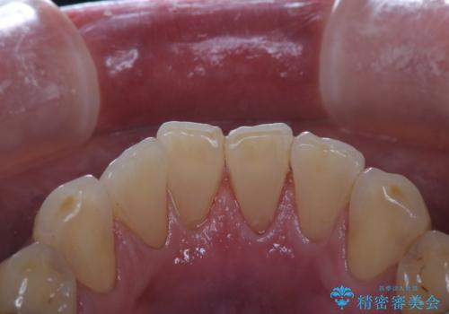 イベント前に綺麗な歯にしたいの治療後