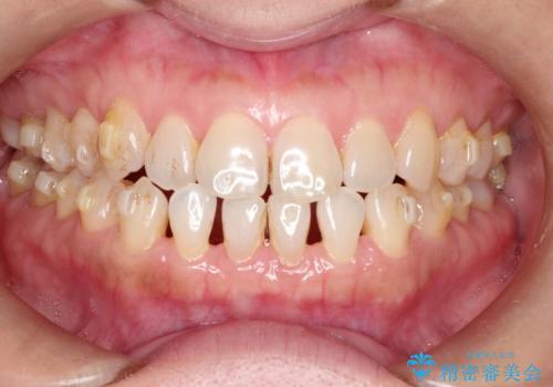 前歯の隙間 インビザラインによる目立たない成人矯正の治療中