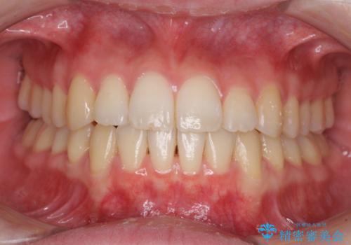 気になる前歯を整えたい　インビザライン・ライトでの矯正治療の症例 治療後