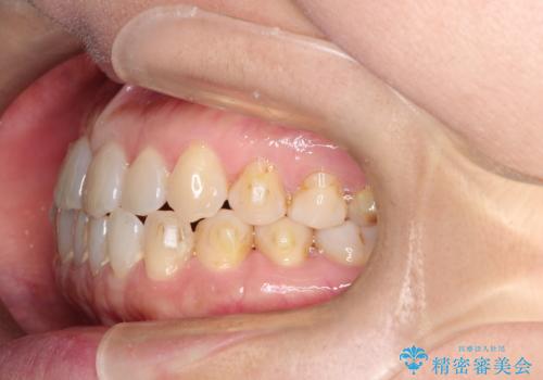前歯の隙間　インビザラインによる目立たない成人矯正の治療中