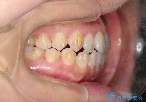 前歯の隙間 インビザラインによる目立たない成人矯正の治療中