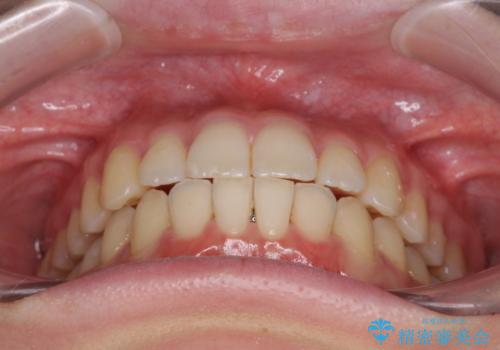 気になる前歯を整えたい インビザライン・ライトでの矯正治療の治療後