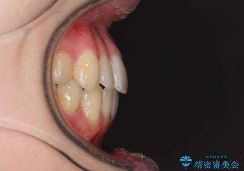 気になる前歯を整えたい インビザライン・ライトでの矯正治療の治療後