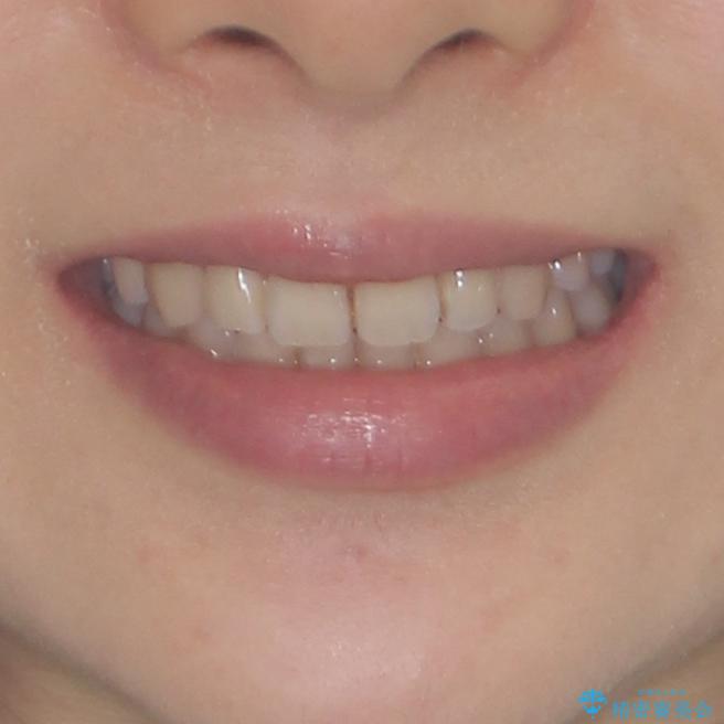 前歯2本が欠損　抜歯矯正でデコボコを治すの治療後（顔貌）