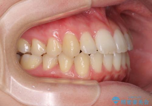 気になる前歯を整えたい インビザライン・ライトでの矯正治療の治療後