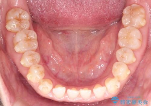 前歯の隙間 インビザラインによる目立たない成人矯正の治療中