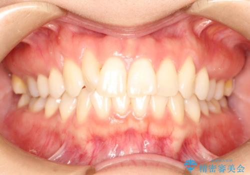 インビザラインによる矯正治療　前歯を整った歯並びへの症例 治療前