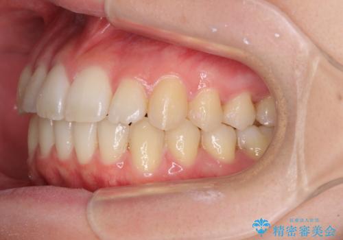 気になる前歯を整えたい インビザライン・ライトでの矯正治療の治療後