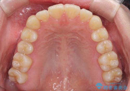 気になる前歯を整えたい インビザライン・ライトでの矯正治療の治療後