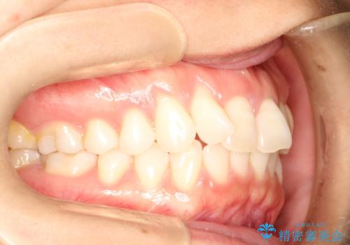 インビザラインによる矯正治療 前歯を整った歯並びへの治療前