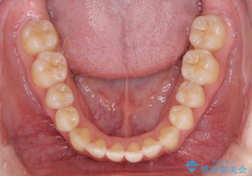 気になる前歯を整えたい インビザライン・ライトでの矯正治療の治療後