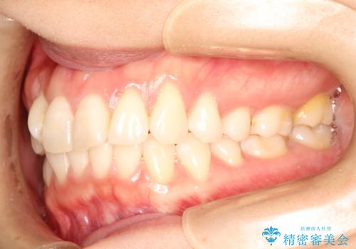 インビザラインによる矯正治療　前歯を整った歯並びへの治療前