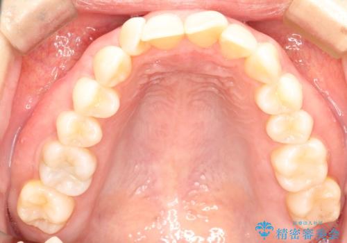 インビザラインによる矯正治療 前歯を整った歯並びへの治療前