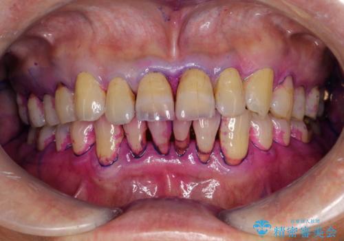 2カ月おきにメンテナンスの治療前