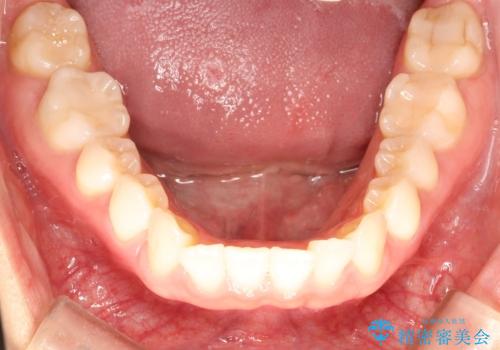インビザラインによる矯正治療 前歯を整った歯並びへの治療前