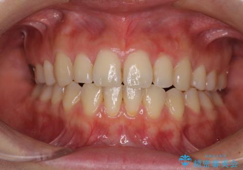前歯2本が欠損　抜歯矯正でデコボコを治すの症例 治療後