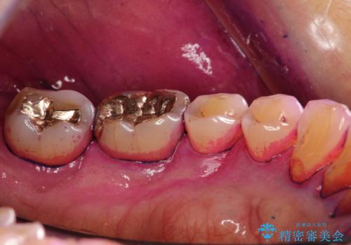 2カ月おきにメンテナンスの治療前