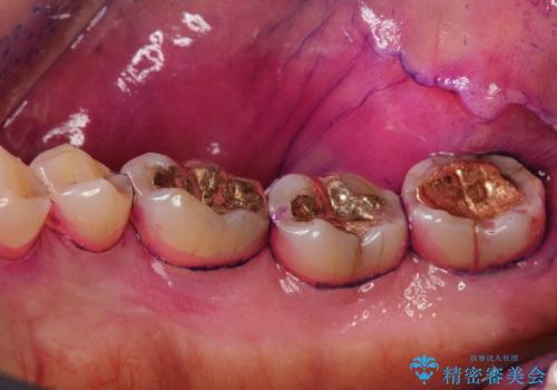 2カ月おきにメンテナンスの治療前
