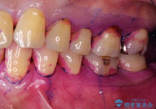 2カ月おきにメンテナンスの治療前