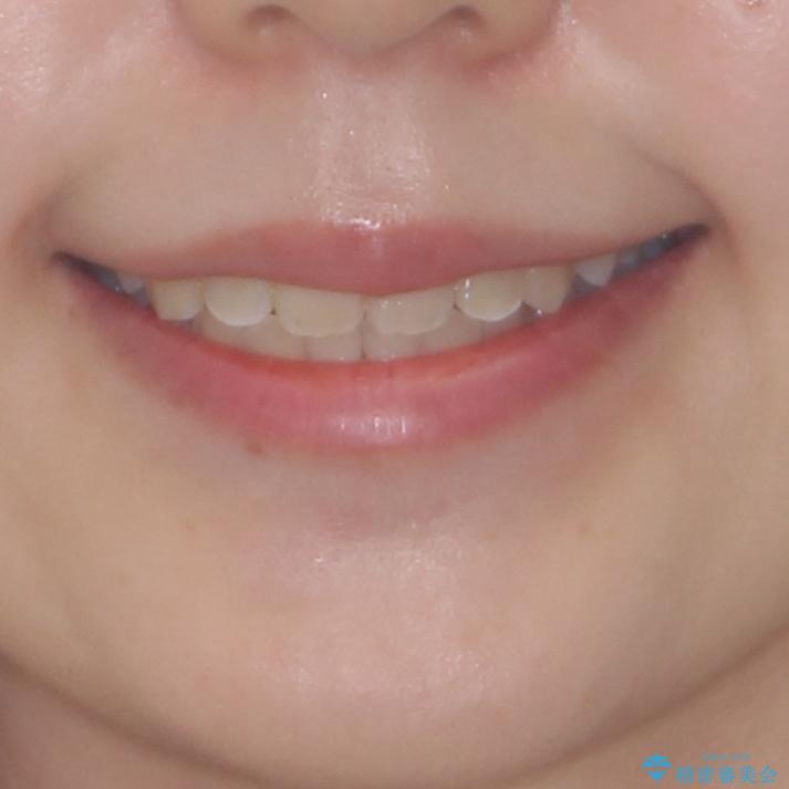 前後に重なった前歯　ワイヤー装置と急速拡大装置を併用したインビザライン矯正の治療後（顔貌）