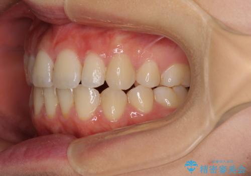 前歯2本が欠損　抜歯矯正でデコボコを治すの治療後