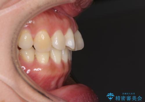 軽度な歯列不正　インビザライン・ライトによる矯正治療の治療前
