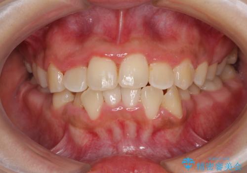 前後に重なった前歯 ワイヤー装置と急速拡大装置を併用したインビザライン矯正の治療中