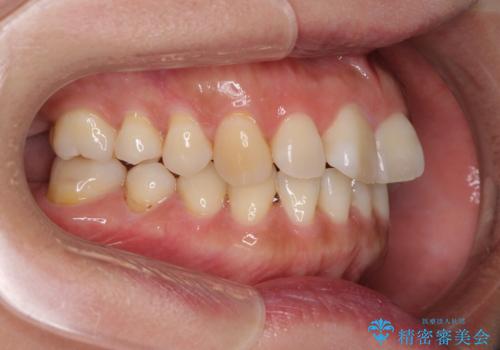 軽度な歯列不正　インビザライン・ライトによる矯正治療の治療前