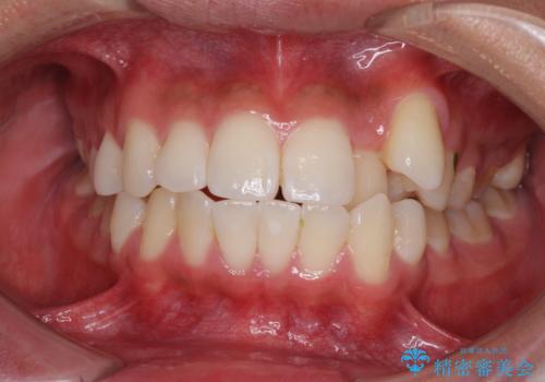 八重歯と奥歯のクロスバイト　上顎骨を拡大してインビザラインで矯正の治療前